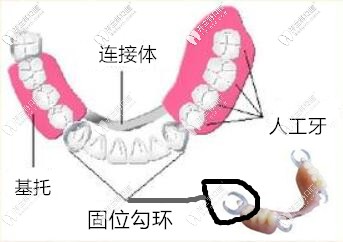 隱形義齒雖然也是活動(dòng)義齒但是區(qū)別還是有點(diǎn)大