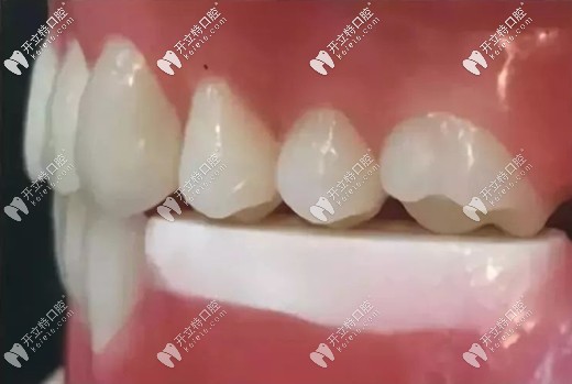 戴臨時(shí)義齒還可防止植體周?chē)吒街? border=