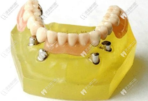 長(zhǎng)期戴用過(guò)渡性義齒是會(huì)引起牙齦萎縮的