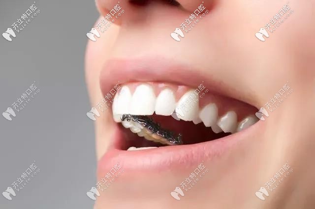 舌側(cè)隱形牙套進口和國產(chǎn)的矯正效果有區(qū)別嗎?價格竟差2萬多
