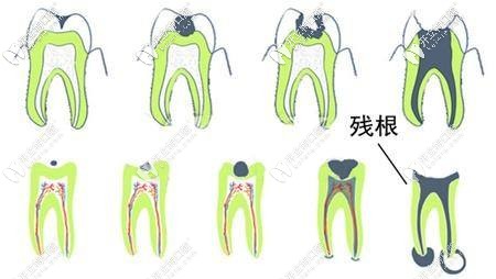 拿什么拯救你20幾年沒(méi)拔的牙齒殘根,不拔掉會(huì)怎么樣