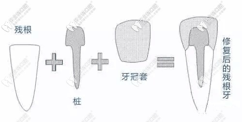 爛牙根修復(fù)后圖示 爛牙根修復(fù)后圖示