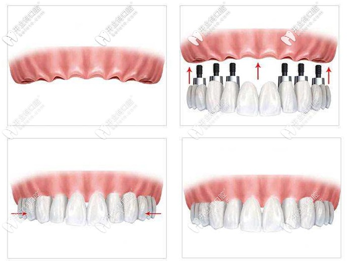 安利一下什么是韓國美格真種植體