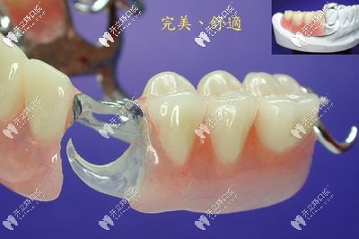 干貨來(lái)了：同為臨時(shí)牙冠的即刻義齒和臨時(shí)義齒有區(qū)別嗎？