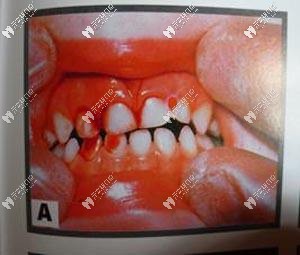 牙震蕩的表現(xiàn)