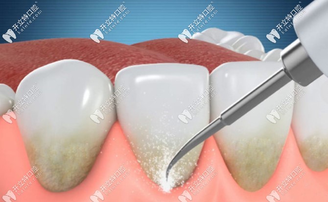 齦下刮治在什么情況下需要做