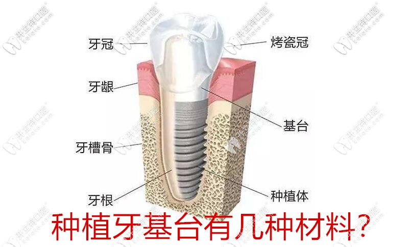 種植牙基臺(tái)有幾種材料?文中有種植牙基臺(tái)種類圖的大介紹喲