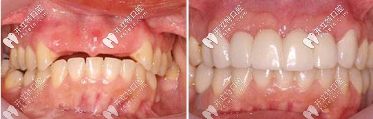 種植牙前后對(duì)比圖
