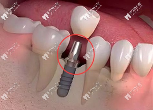 基臺是種植牙系統(tǒng)中非常重要的一個部件
