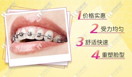 屬于你的金屬牙齒矯正優(yōu)惠活動