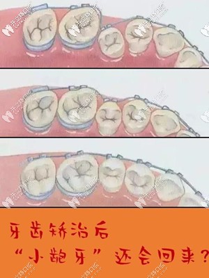 矯正后要注意牙齒反彈