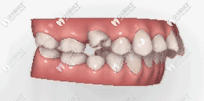 超全科普：隱適美推磨牙向后知識(shí)全都在這里了