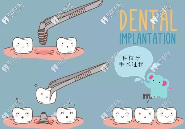 微創(chuàng)種植牙手術(shù)過(guò)程圖解