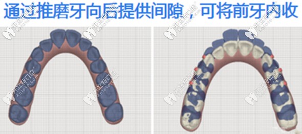 通過(guò)推磨牙向后提供間隙來(lái)將前牙內(nèi)收