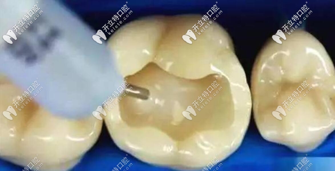 樹脂嵌體和瓷嵌體價格相差那么大，到底有啥區(qū)別？