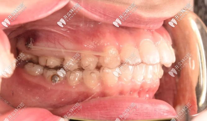 打了骨釘后的圖片