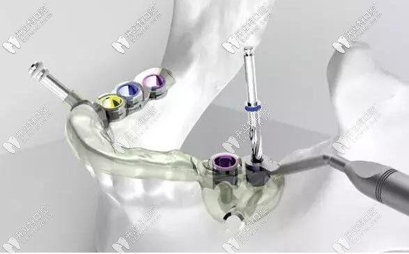 數(shù)字化3D導(dǎo)板種植牙中的導(dǎo)板