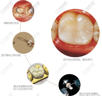 現(xiàn)技術(shù)瓷貼面兩小時(shí)就可以完成