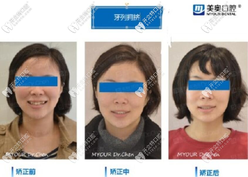 【案例分享】你知道嗎,時代天使也可以磨牙后推哦