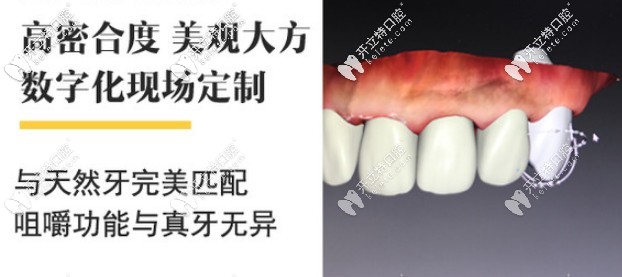澤康、威蘭德、吉爾巴赫全瓷牙該選哪個(gè)牌子