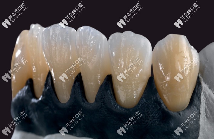 吉爾巴赫全瓷牙的優(yōu)點(diǎn)