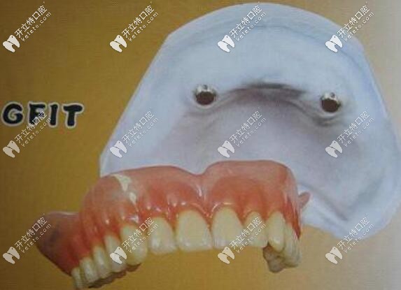 磁性精密附著義齒