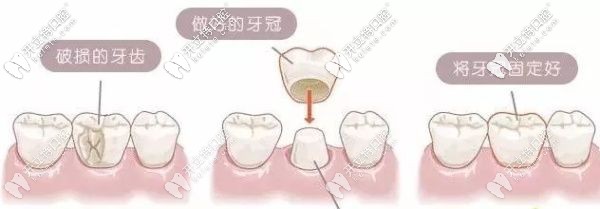 解答：門牙缺了一小塊是選牙齒貼面還是全瓷牙好呢？