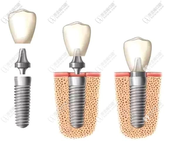 種植體埋入牙槽骨過程