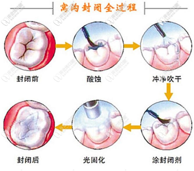窩溝封閉的過程