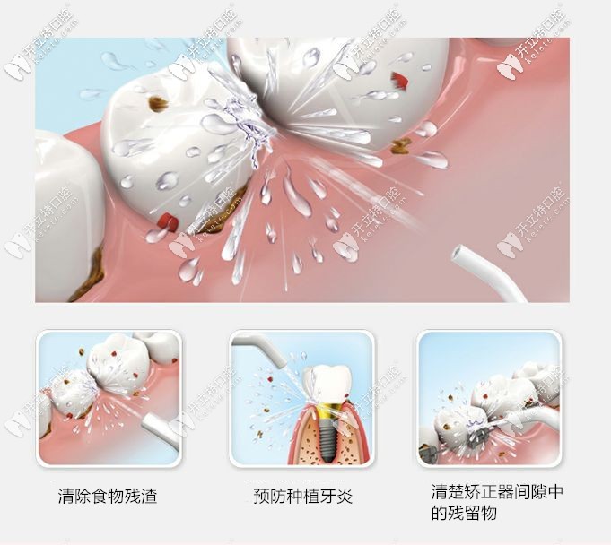 水牙線(xiàn)好處