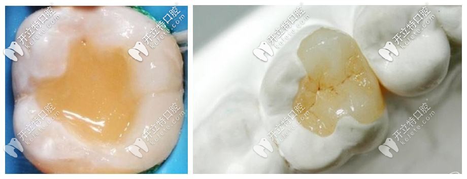 嵌體為什么老掉呢?假如牙嵌體掉了再粘回去要錢嗎？