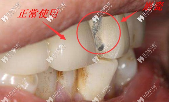 牙冠的合理設(shè)計也是影響使用壽命的重要因素