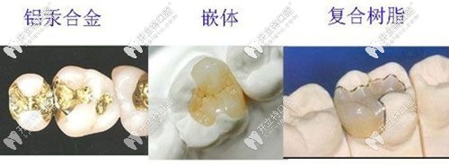 補(bǔ)牙的各種材料