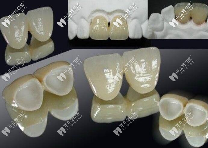 二氧化鋯全瓷牙