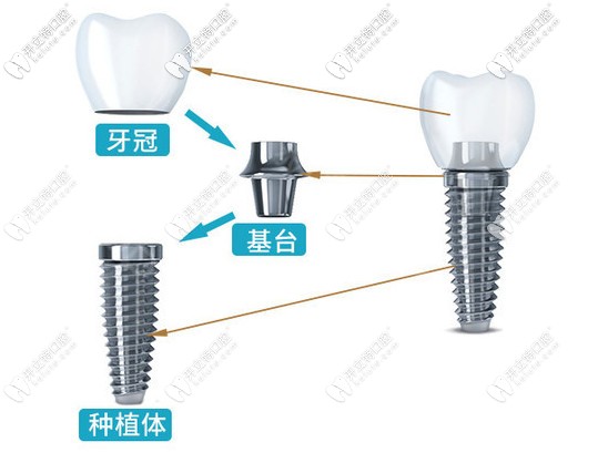 韓國登騰種植牙