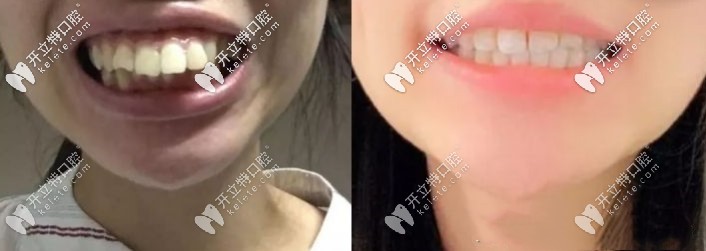 隱適美矯正齙牙前后對比照