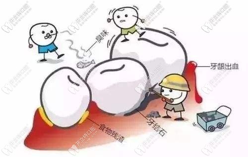 潔牙可以去除食物殘?jiān)脱澜Y(jié)石