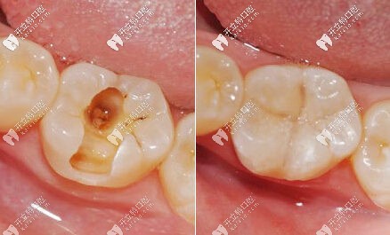 補牙的前后對比圖