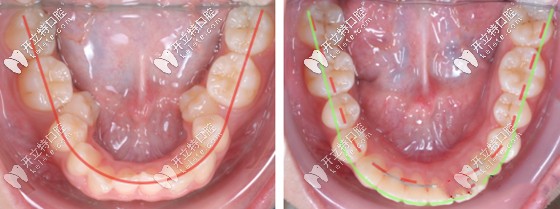 牙齒擴(kuò)弓矯正前后效果對比圖