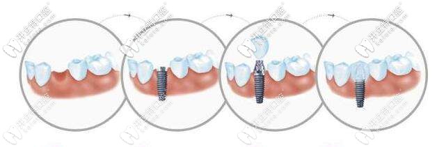 百康種植牙過(guò)程