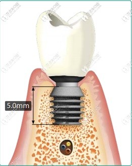 百康種植體的長(zhǎng)度更短