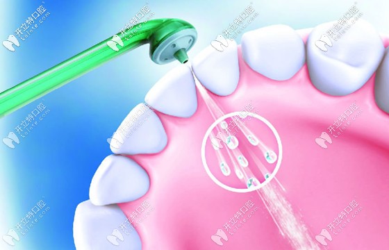 你做過洗牙保健嗎