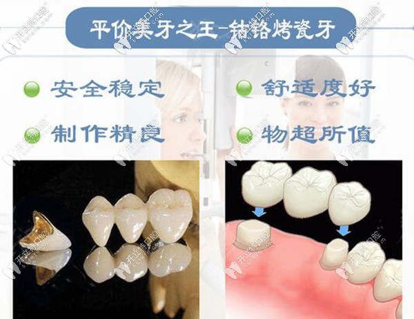 鈷鉻烤瓷牙優(yōu)勢
