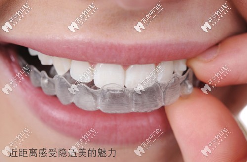 董瑜醫(yī)生是隱適美和時(shí)代天使認(rèn)證醫(yī)師