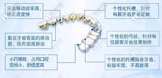 舌側(cè)隱形和唇側(cè)矯正的價格