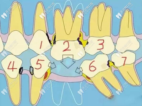 缺一顆牙齒的危害