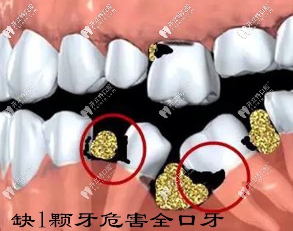 缺一顆牙不補(bǔ)會危害全口健康牙齒
