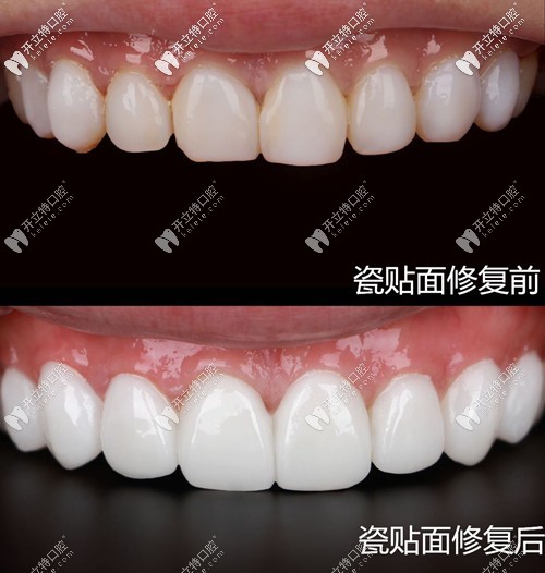 瓷貼面修復(fù)前后對比圖