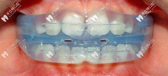 兒童戴MRC矯正器照片