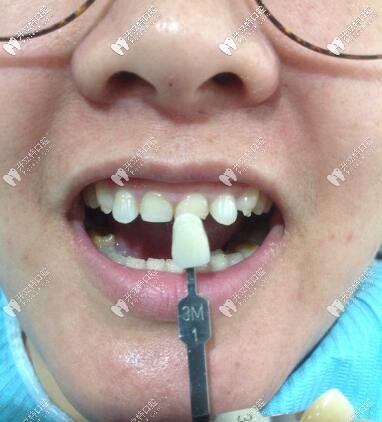 唐山誠(chéng)品口腔門診部瓷貼面真人案例